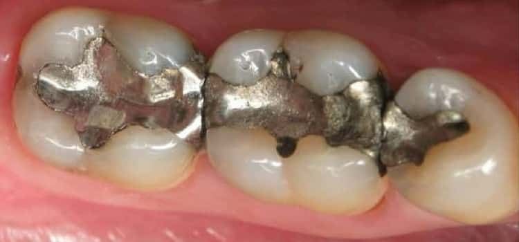 Obturação nos dentes