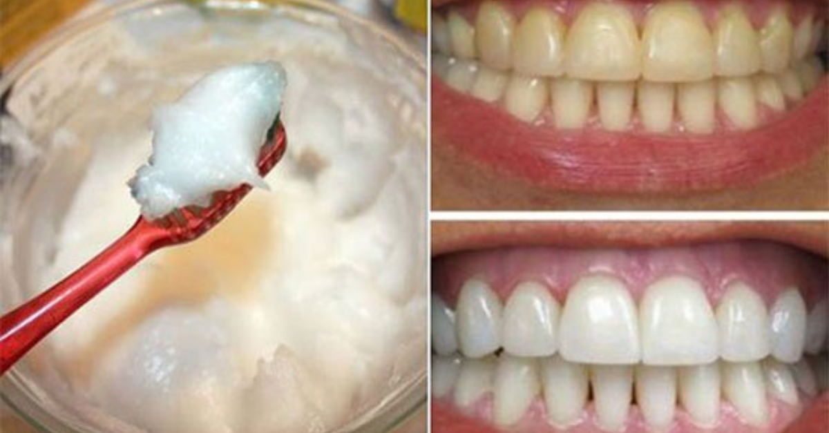 Óleo de coco clareia os dentes?
