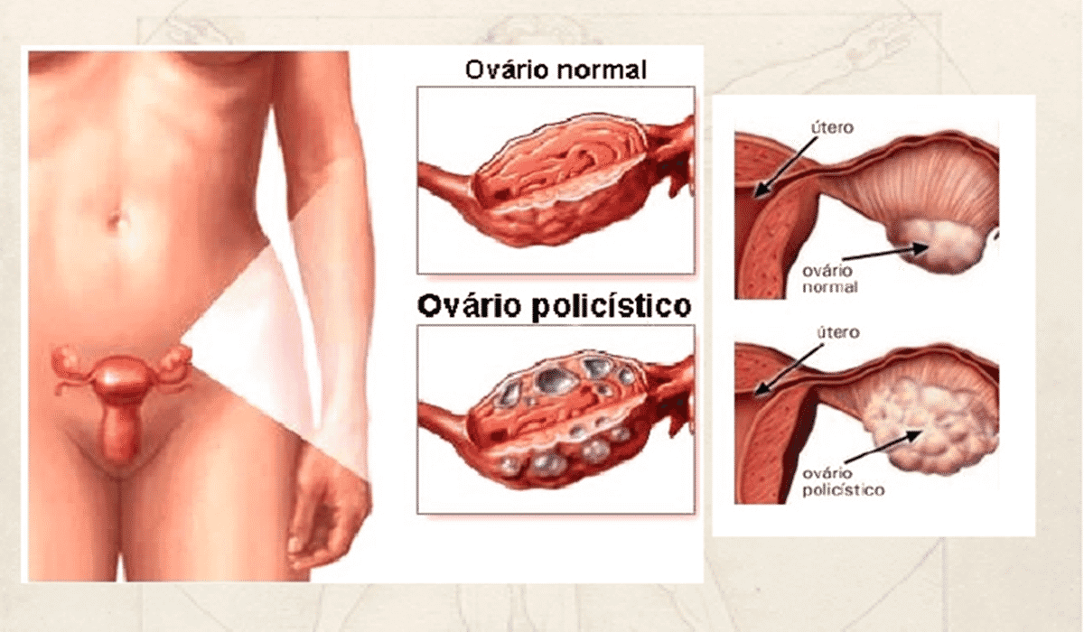ovariopolicistico