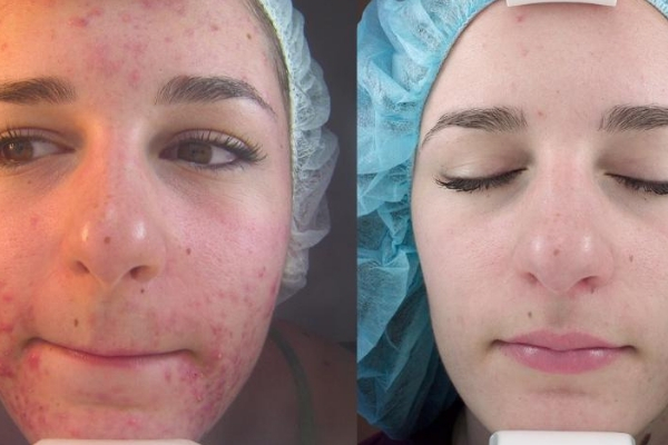 peeling de diamante resultado tratamento acne