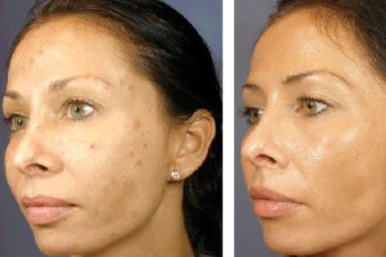 O que é e para que serve o peeling de diamante