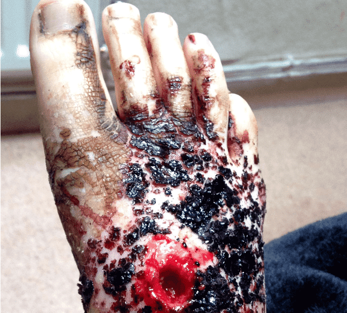 perde-perna-unha-encravada-3