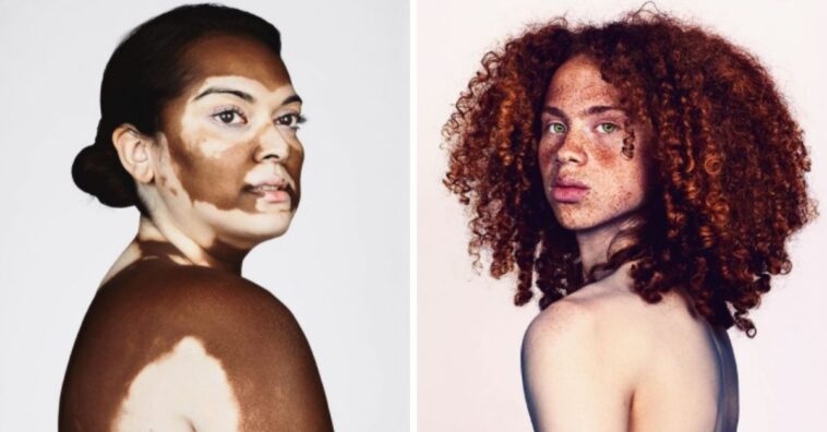 pessoas com sardas e vitiligo