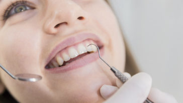 placa bacteriana o que é e como remover