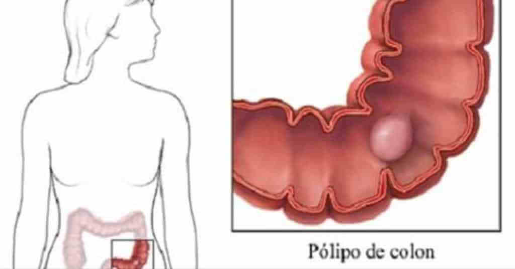 Pólipo intestinal saiba o que é