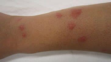 pomadas para picada de inseto