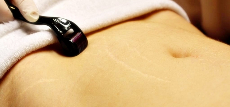 preço do microagulhamento para estrias