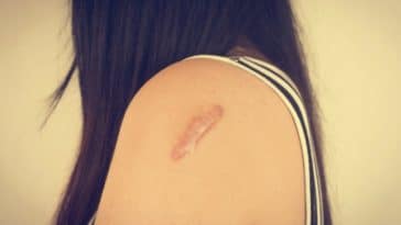 como evitar cicatriz