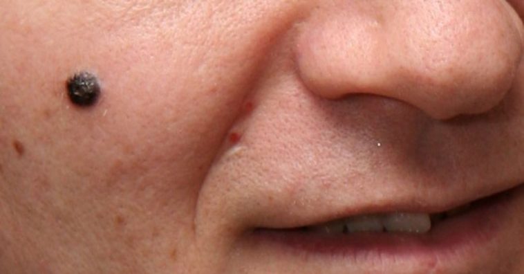 sintomas de câncer de pele