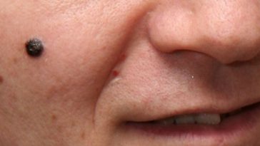 sintomas de câncer de pele