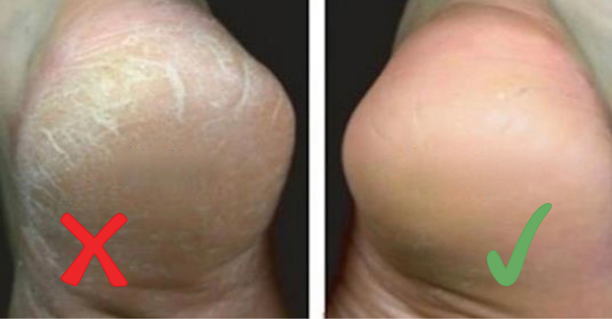 Rachadura nos pés: o que causa e como tratar de forma eficaz
