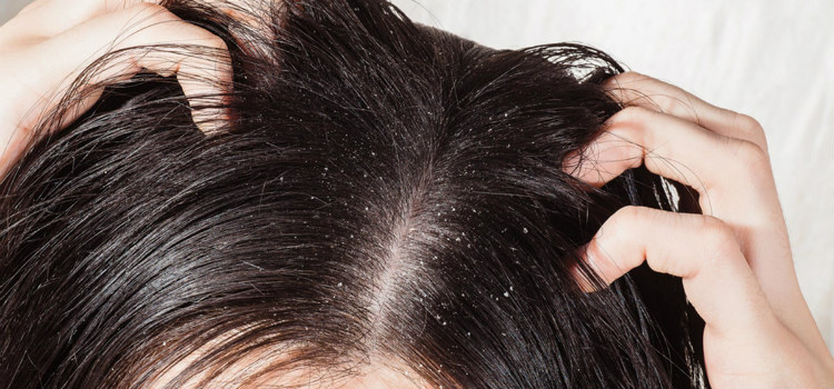 mitos e verdades sobre a caspa