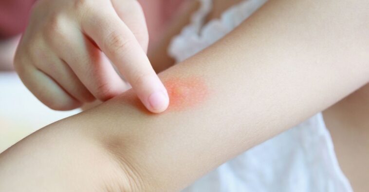 quando picada de inseto é preocupante