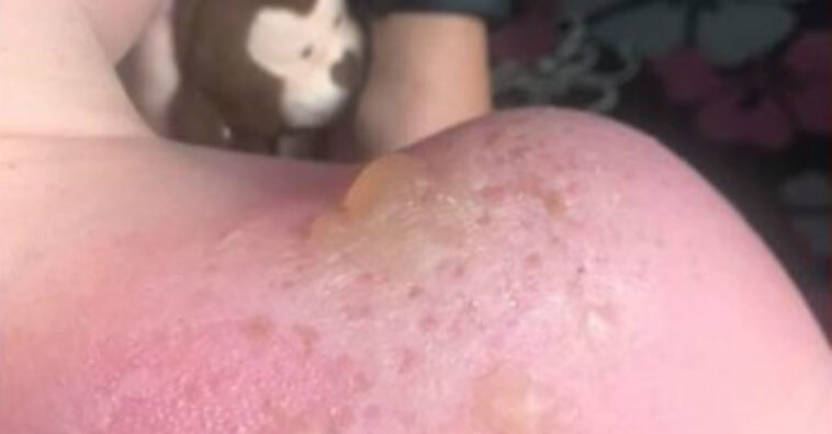 queimadura com protetor solar