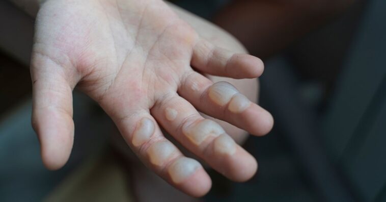 queimadura em crianças