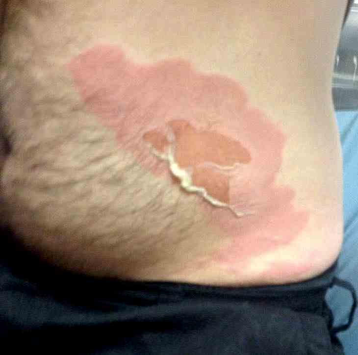 queimadura-panela-pressao-1