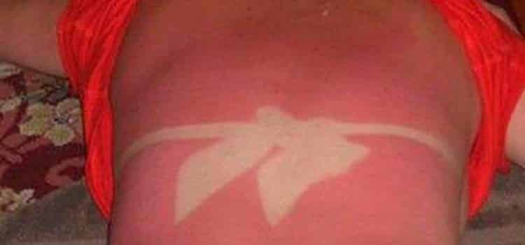 Mulher com marca de sol nas costas