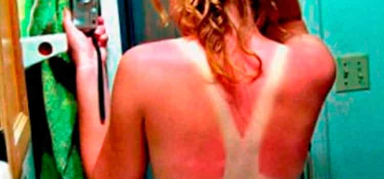 marcas de queimadura de sol