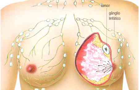 rastreio-cancro-da-mama