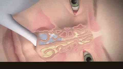 remédio para sinusite