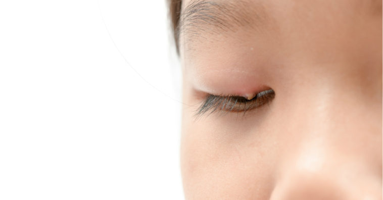 remedios caseiros para terçol