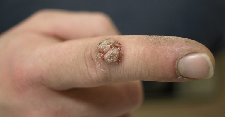 remédios caseiros para verrugas como usar