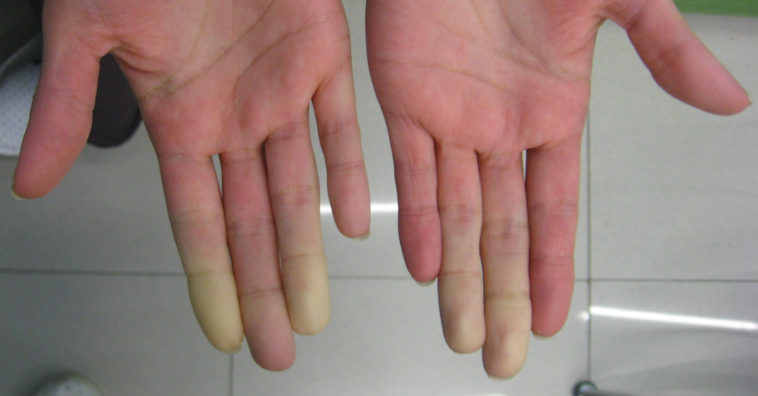 síndrome de raynaud