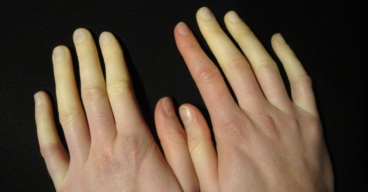 síndrome de raynaud como se prevenir
