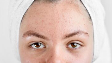 sabonete para espinhas