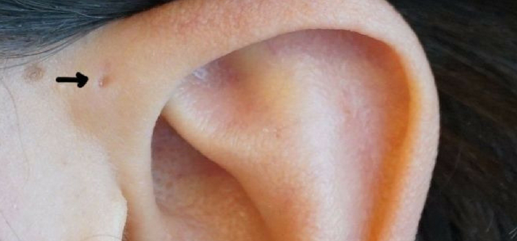 sobre seio pré-auricular