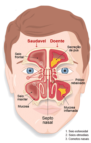Tratar sinusite: seios nasais