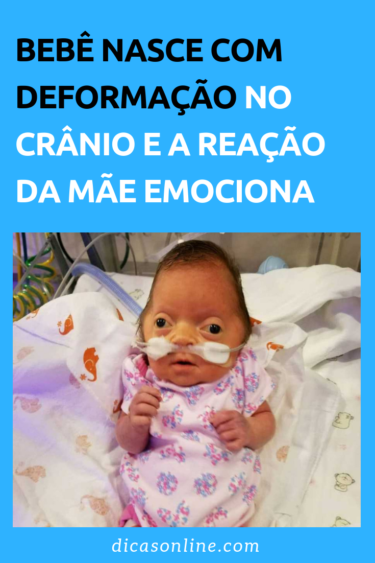 sindrome de pfeiffer