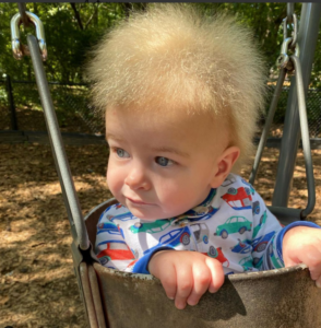 síndrome do cabelo impenteável