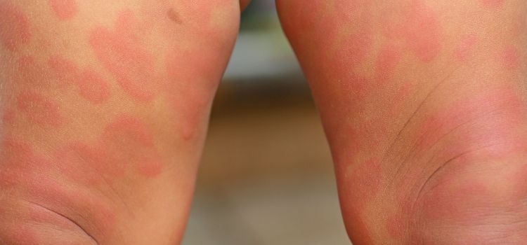 principais sintomas de alergia ao calor