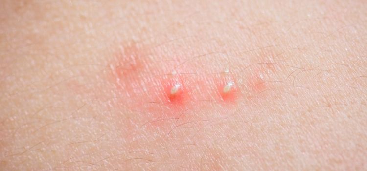 sintomas e tipos de foliculite