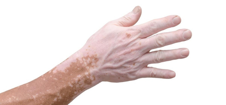 sobre doença vitiligo
