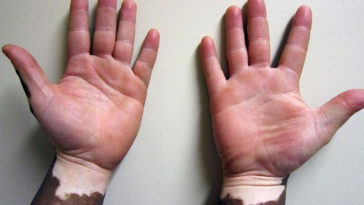 vitiligo ou pano branco