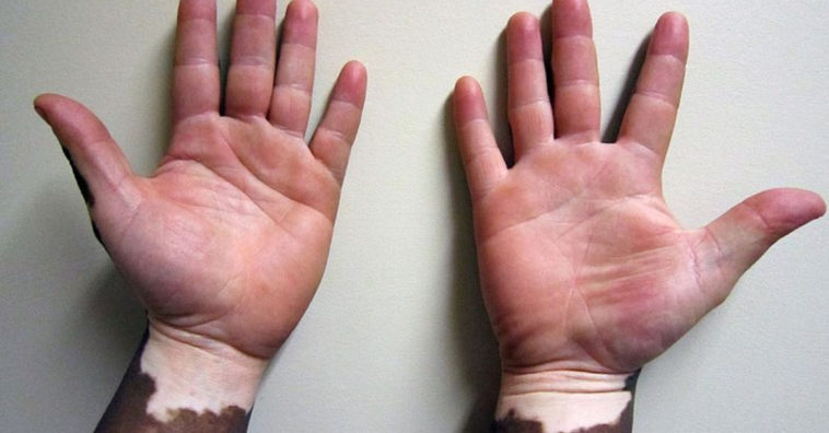 vitiligo ou pano branco