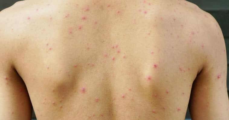 tipos de alergia comuns