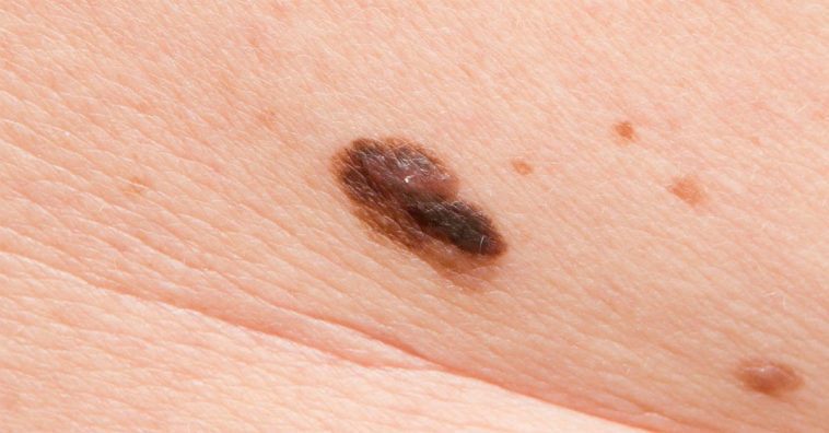 tipos de cancer de pele