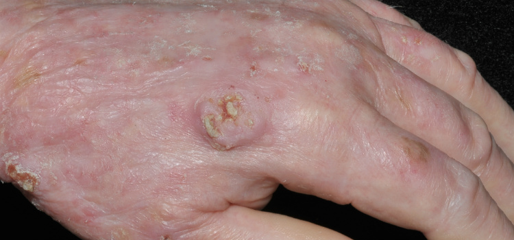 tipos de câncer de pele carcinoma espinocelular