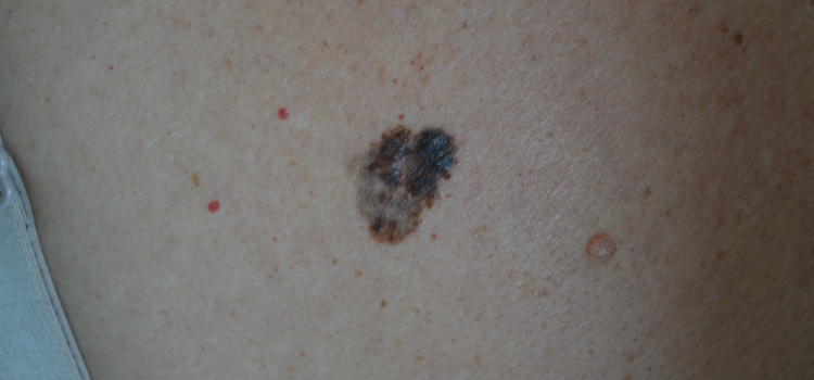 tipos de câncer de pele melanoma