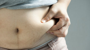 tipos de gordura abdominal
