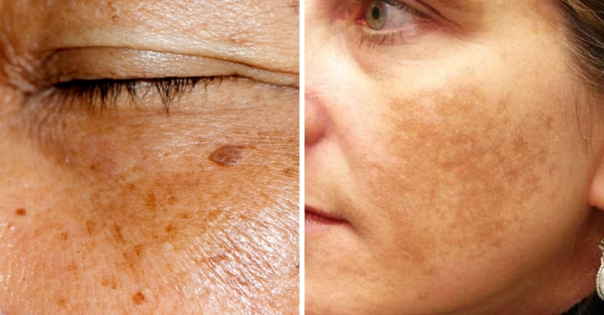 Como tirar manchas do rosto? 5 dicas