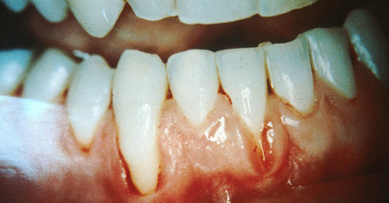 tratamento caseiro para retração gengival