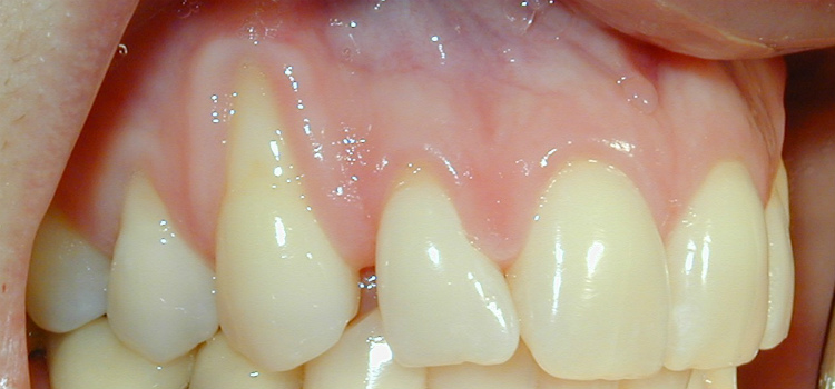 tratamento caseiro para retração gengival como tratar