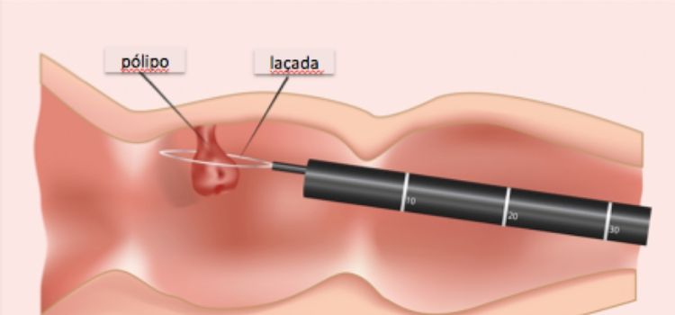 tratamento de pólipo intestinal