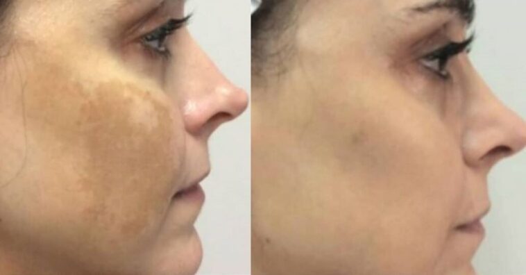 tratamento para melasma da atriz alexandra martins