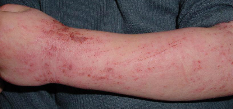 tratamento caseiro para eczema