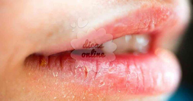 Como tratar lábios ressecados